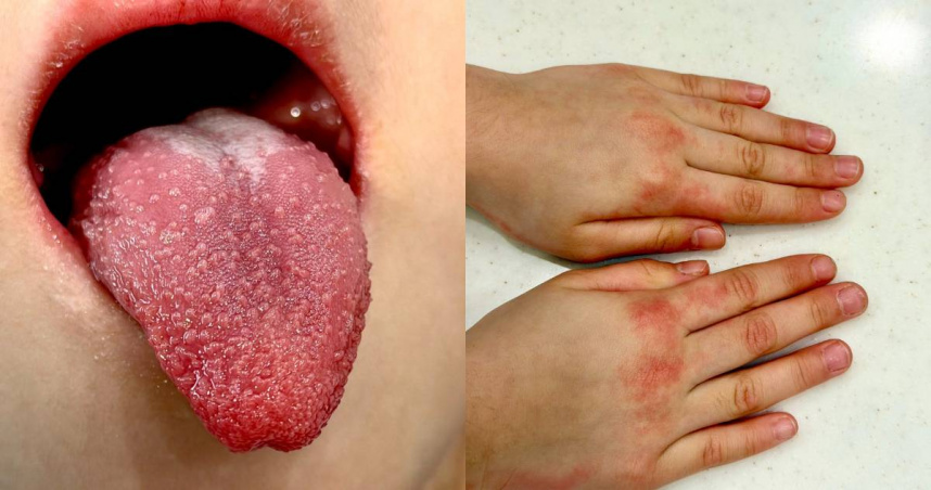 1名4歲女童連燒多日未退，伴隨紅疹、結膜充血、手掌紅腫與「草莓舌」等症狀。（圖／翻攝自臉書，柳雱邁小兒科）