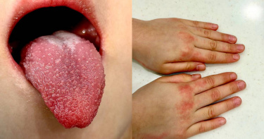 1名4歲女童連燒多日未退，伴隨紅疹、結膜充血、手掌紅腫與「草莓舌」等症狀。（圖／翻攝自臉書，柳雱邁小兒科）