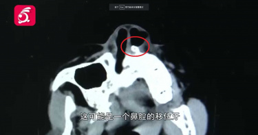 女童跌倒「門牙噴飛」找不到!3年後狂流血...驚見「牙齒卡鼻腔」