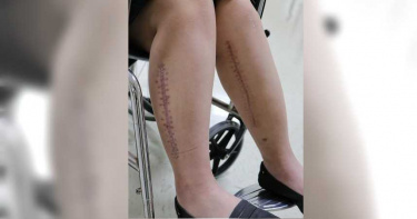 5專科醫師24小時齊力搶救 妙齡女中風後奇蹟恢復