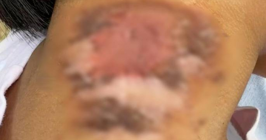 王女士的四歲女兒因誤沾隱翅蟲毒液導致嚴重皮炎。（圖／翻攝自極目新聞）