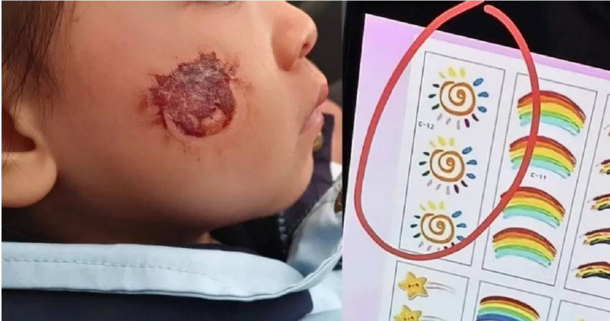 大陸湖南一名3歲女童參加幼兒園活動，聽老師的話在臉上貼貼紙，沒想到造成皮膚損傷，讓家長很崩潰。（圖／翻攝自微博／瀟湘晨報）