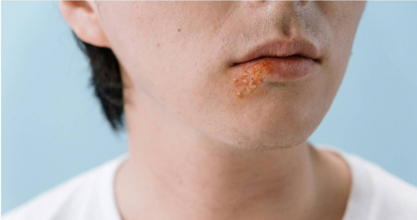 基因醫師張家銘示警，皰疹不只是水泡，還會加速阿茲海默症的發作。（示意圖／翻攝自pexels）