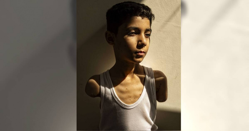 九歲男孩馬哈茂德，因為戰爭而斷了雙臂的照片，奪下2025世界新聞攝影大賽年度照片。（圖／翻攝自世界新聞攝影大賽官網）