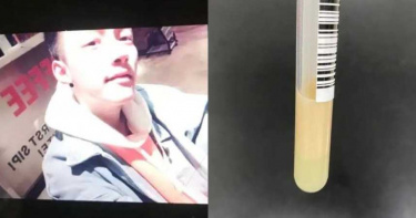 19歲陽光型男遭蛇狠咬!抽出「黏稠牛奶血」…網驚:牠救你一命