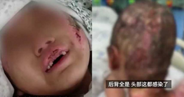 熱水澆頭、鉗拔門牙!6歲女童遭虐3個月…爸崩潰:她一輩子禿頭