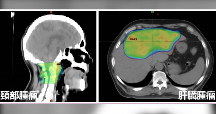 台中一名男子「麻糬伯」因癱瘓就醫，竟發現癌細胞擴散到頸椎，且肝臟內有一顆20公分的巨型腫瘤。（圖／亞大附醫提供）