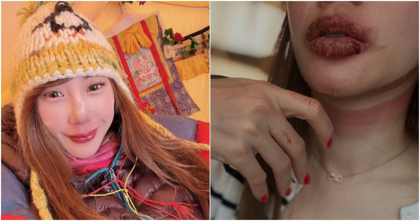 曾格爾曬出自己攀登聖母峰的傷照。（圖／擷取自Facebook／曾格爾 Grace Tseng）