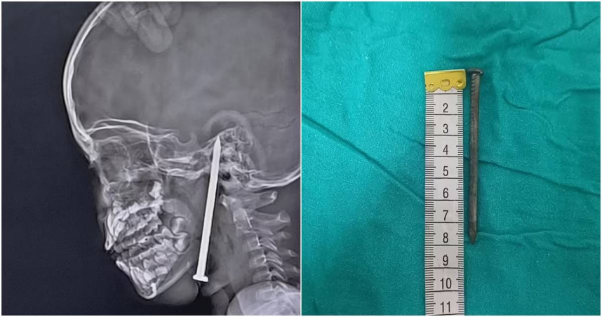 近日，印度北方邦伯爾拉姆布爾縣一名7歲男童玩耍時不慎跌倒，導致一根3英吋（約7.62公分）的鐵釘從頸部直刺入腦。（圖／翻攝X）