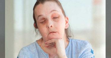她遭前夫潑鹼毀容眼瞎 整形73次…歷經20小時移植手術「換臉重生」