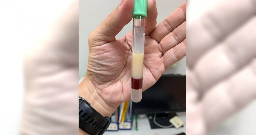 高血脂病患的血液最上層真的浮現一層油。（圖／翻攝自Facebook／Icu醫生陳志金）