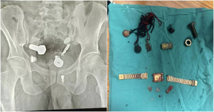 印度一名男子因嚴重腹痛到難以飲食而就醫，醫師本以為只是尋常的消化道問題，誰知在為他進行X光掃描時，意外在他體內發現了一系列匪夷所思的異物。（圖／翻攝Mirror）