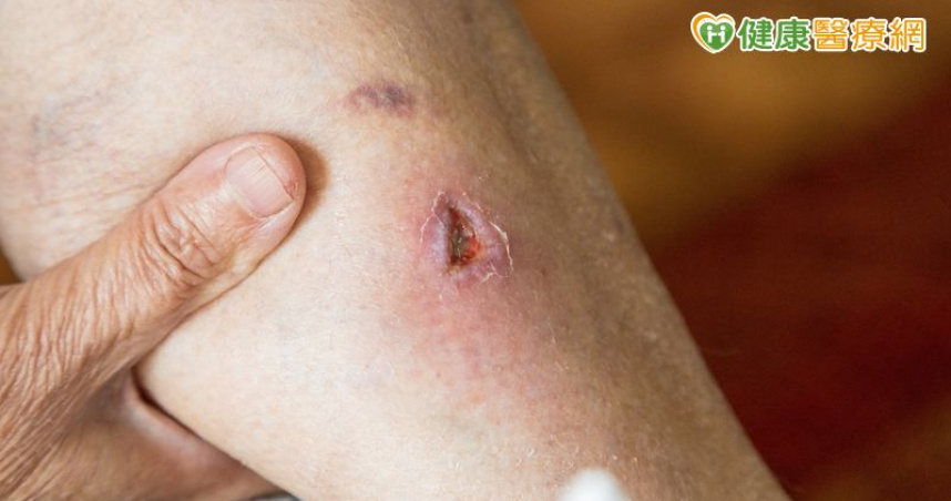 他傷口一直好不了險遭截肢！「1治療方式」解除危機