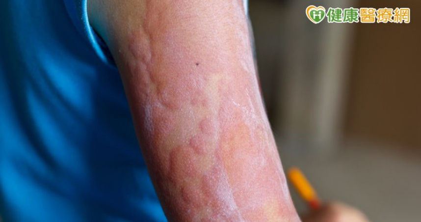 小一童異位性皮膚炎重度發作不敢上學！　「1精準治療」助自信重返校園