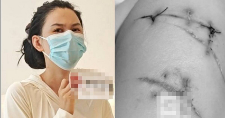 大陸浙江一名馬姓女子逛街遭陌生男挾持,對方持刀朝她胸部狂捅22刀,幸運的是,她曾做隆乳手術,假體替她擋了致命攻擊,經搶救沒有生命危險。(圖/翻攝自微博)