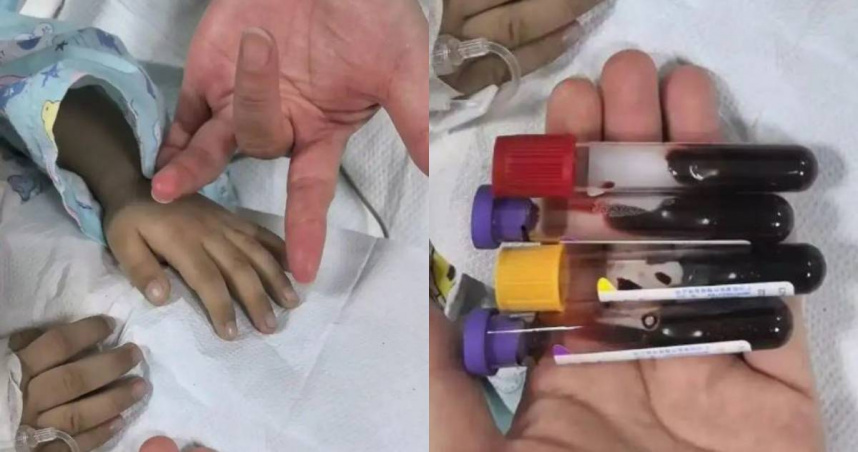 3歲男童的皮膚異常發青發紫，確認為亞硝酸鹽中毒。（圖／翻攝微博）