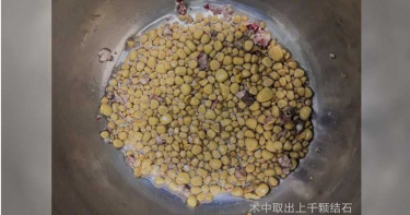 上班族愛喝酒吃肉少喝水 體健後驚見腎臟有1258顆結石!