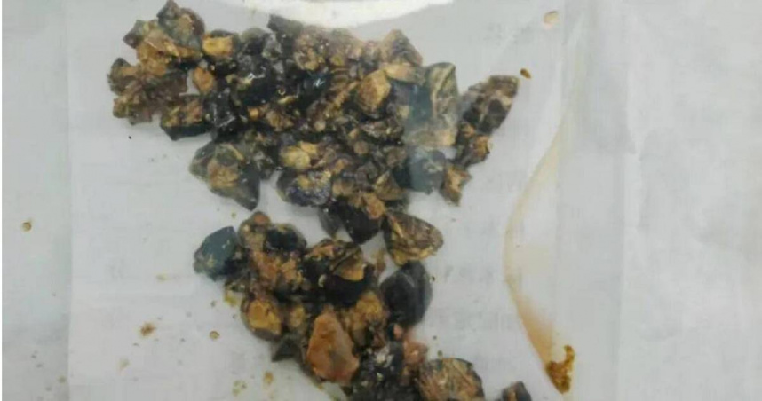 大陸南京一名女子飲食不規律，體內竟有60多顆結石。（圖／翻攝自微博／紫牛新聞）