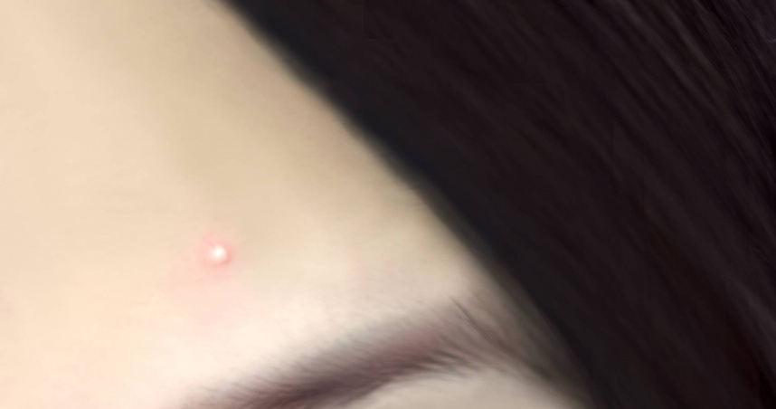 醫師林昀萱提醒，如果是粉刺、囊腫痘、紅腫痘，若使用痘痘貼，恐讓狀況更嚴重。（示意圖／photoAC）