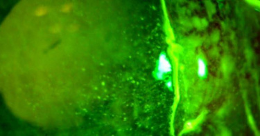 大陸福建省一名胡姓男子日前騎乘電動車時，遭飛蚊入眼，竟引發嚴重的真菌性角膜潰瘍。（圖／翻攝自微博）