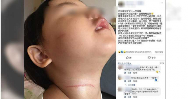 風箏成凶器! 女童大湖公園玩耍遭「風箏線割頸」