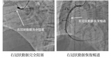 39歲男子追劇追到一半突然心肌梗塞，經送中港澄清醫院急診，經緊急心導管，發現右冠狀動脈完全阻塞（左圖），經過支架置放後，總算回復了血流（右圖），心跳也穩定下來。（圖／澄清醫院提供）