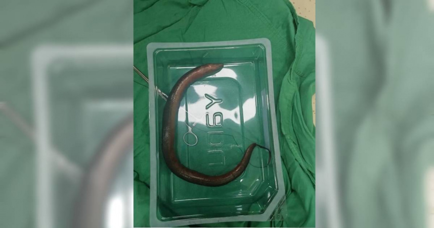 湖南一名男子到急診求救，醫師檢查發現他腹腔內竟有30公分長的鱔魚。（圖／翻攝自微博／瀟湘晨報）