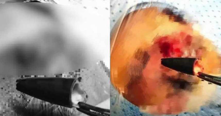 大陸廣東深圳一名46歲男子近期眼睛疼痛，還流出膿液，就醫發現他眼眶內有2.5公分的原子筆頭。（圖／翻攝自微博／第一現場）