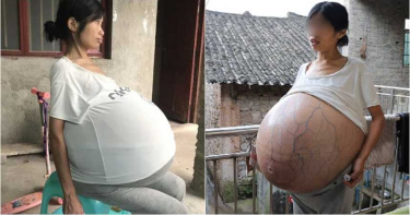 少婦肚子冒20kg腫瘤「青筋密布」快炸開 她已等死2年…哭只能「坐著睡」