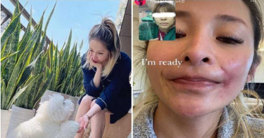 愛的主打歌天后PO「I’m ready」!蕭亞軒被愛犬咬傷首曝無碼照 驚留「這一大條」
