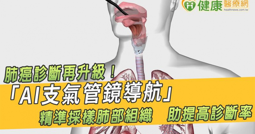 肺癌診斷再升級！「AI支氣管鏡導航」精準採樣肺部組織　助提高診斷率