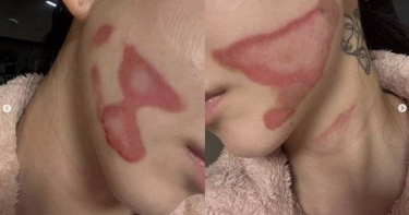 南韓女子團體AOA前成員權珉娥近日在社群媒體上披露，自己在皮膚科接受醫美療程時遭受燒燙傷，導致臉部毀容。（圖／翻攝自IG，new.kma）