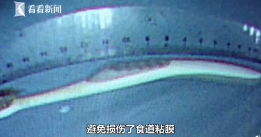失控男怒吞「20cm牙刷」!7小時後才就醫「胃粘膜出血」