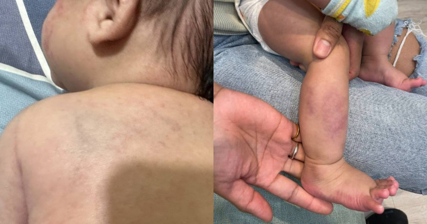 桃園市八德區一名家長控訴，孩子疑似遭到保母虐待，身上有多處瘀青。（圖／翻攝自臉書／記憶八德）