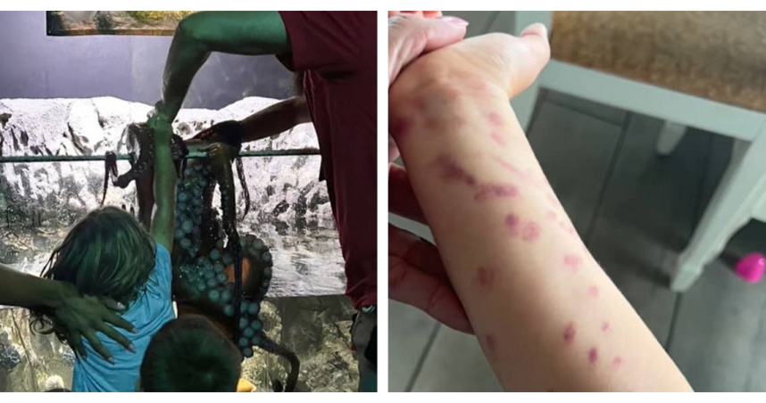 德州一名6歲男童在觸摸池與章魚互動時，手臂遭吸盤緊緊吸住，留下明顯瘀痕。（圖／翻攝自TikTok＠BritneyTaryn）