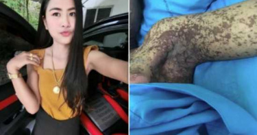 牙痛差點要人命 吃止痛藥引發嚴重過敏