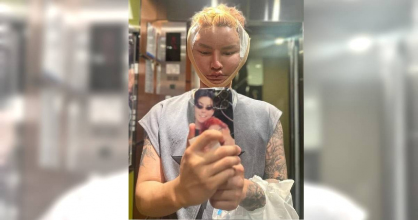 來自新加坡的34歲網紅林旻德，日前特地飛到曼谷，花了60000泰銖（約新台幣58700元）接受醫美拉皮手術，地震當下他已經結束手術，正躺在消腫儀器中。（圖／翻攝聯合早報）