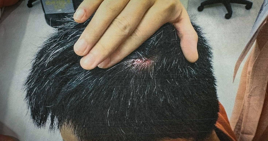 S先生遭枕邊人持玻璃瓶痛毆頭部。（圖／S先生提供）