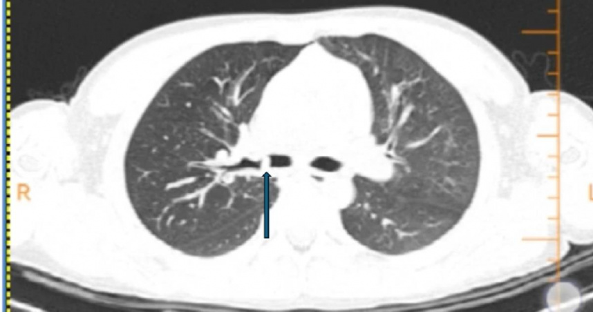 日前，中國廣州一名6歲男童樂樂（化名）在吃飯時意外嗆咳，誰知一咳就咳個不停，甚至加重到「咳出血痰」，讓家長嚇壞送醫。而醫師在檢查後，發現半年前另外一場被家長輕忽的嗆咳，才是如今一連串事件的原兇。（圖／翻攝微博）