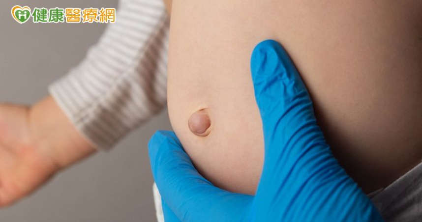 肚臍疝氣常見　腹壓上升是主因