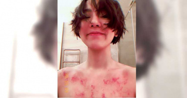 丁噹行程滿檔狂操舞技 養生達人靠刮痧換血疏通筋骨