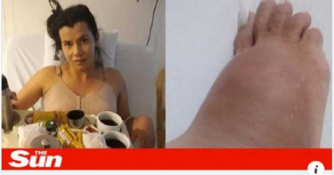 女砸錢豐臀「矽膠流湯」腫成象腿! 頻遭醫師轉診…無人敢動刀