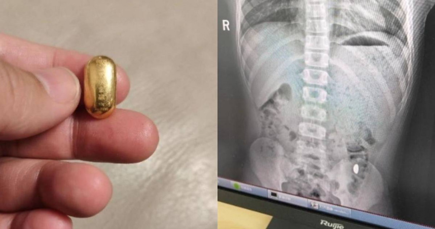 熊孩子誤吞10克金豆，讓媽媽哭笑不得。（圖／翻攝自微博）