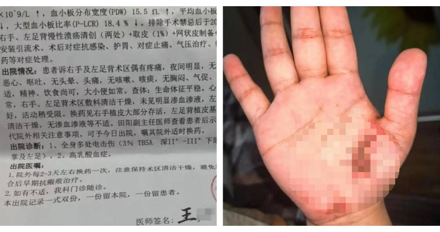 大陸貴州遵義一名孫姓女子邊充電邊滑手機時疑似遭電擊，全身多處灼傷，一度送進ICU搶救。（圖／翻攝自紅星新聞，下同）