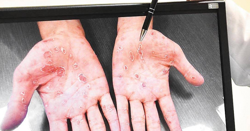 男子手掌出現不痛不癢紅斑，被確診二期梅毒。（示意圖／報系資料照）