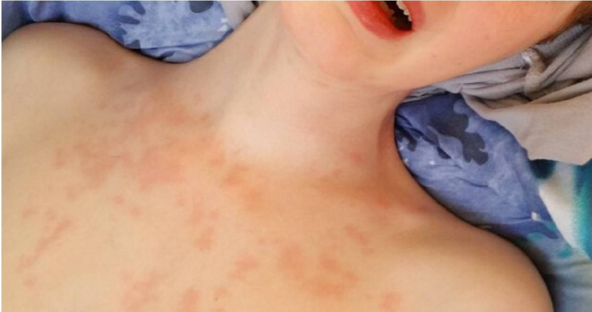 中部一名男子赴馬來西亞出差返台後確診麻疹，疾管署匡列145名接觸者進行健康監測，防範疫情擴散。（示意圖／達志／美聯社）