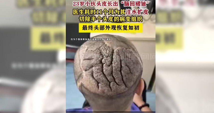 23歲男子罹患罕見頭皮疾病，頭皮長出宛如大腦腦迴的皺褶，歷經11個月治療後終於恢復正常。（圖／翻攝自極目新聞）