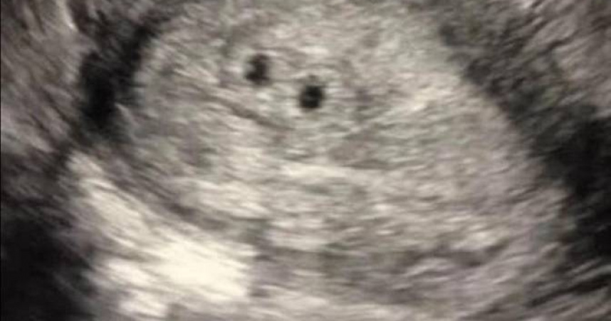 國外一名媽媽以為懷三胞胎，最後卻只生出1個寶寶。（圖／翻攝自vfbabygirl28 TikTok）