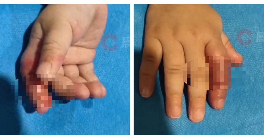 湖南女嬰因綁繃帶戒吃手，手指血流受阻導致壞死，險些截肢。（圖／瀟湘晨報）