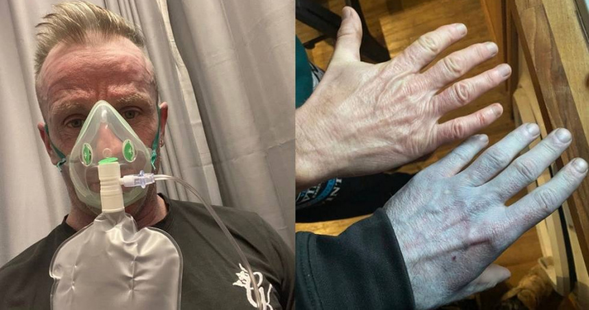 英國一名男子某日睡醒後身上多處變藍藍的，以為罹患怪病立刻奔急診，但最後才發現只是被被單染色。（圖／翻攝自臉書／Tommy Lynch）